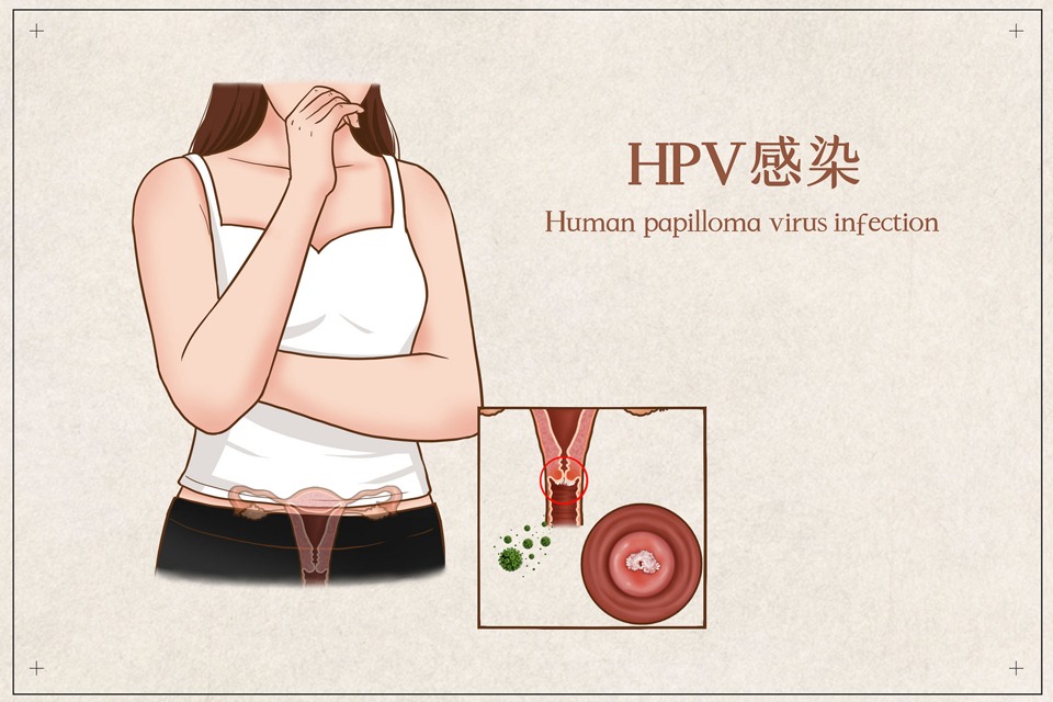 HPV陽性可以買保險