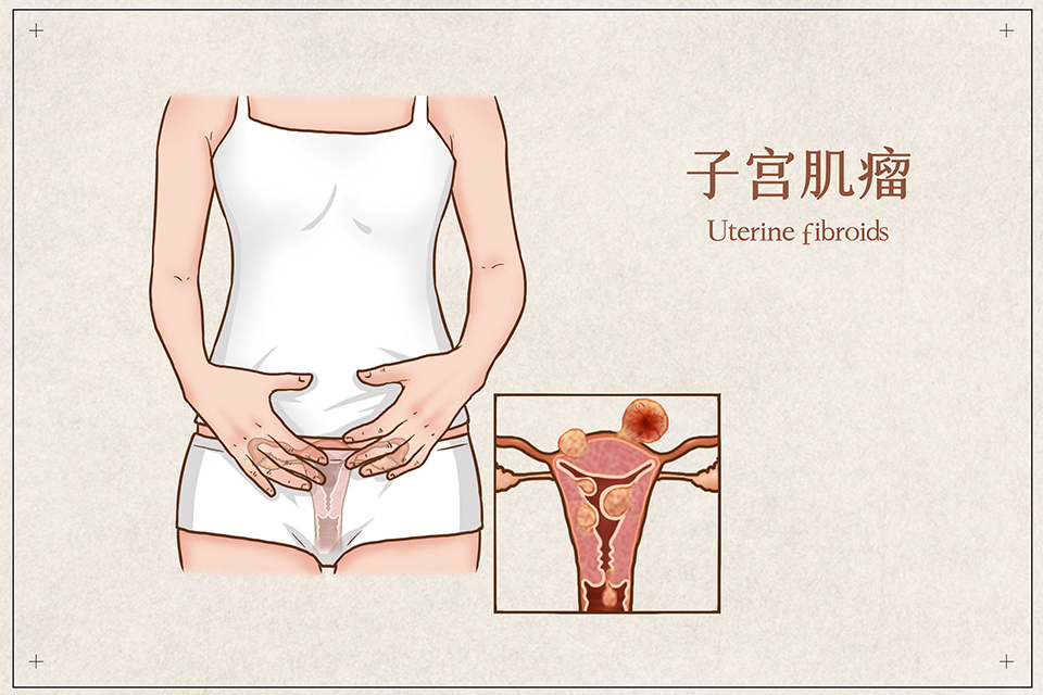 子宮肌瘤,壽險(xiǎn)